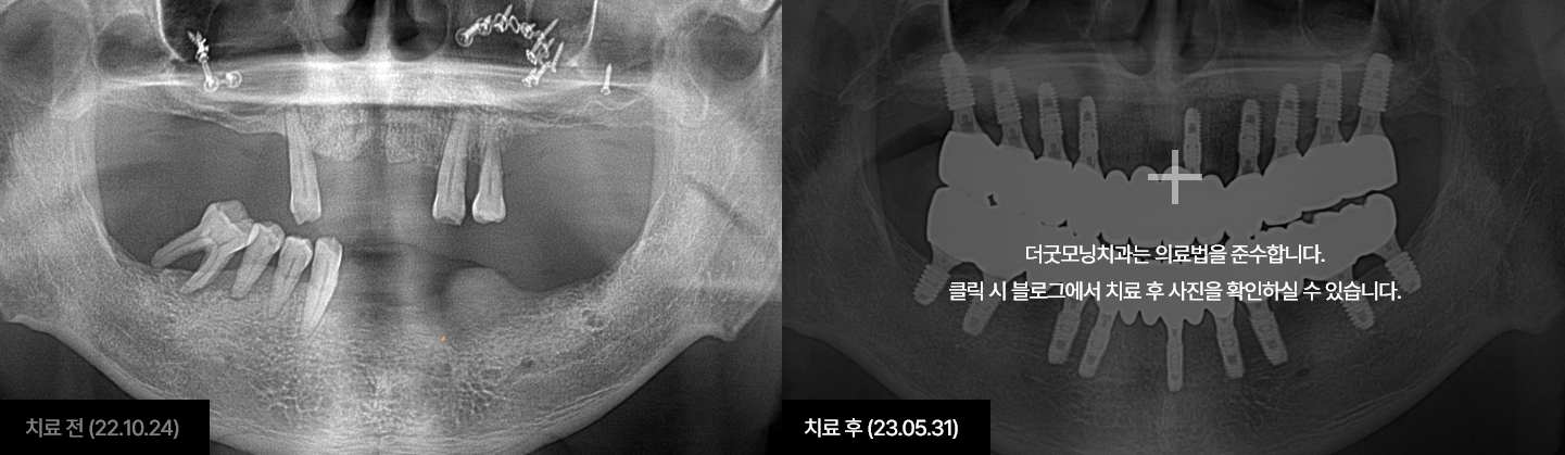 임플란트 케이스 3