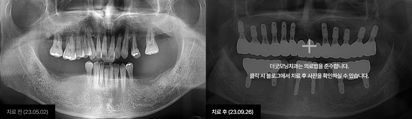 임플란트 케이스 5