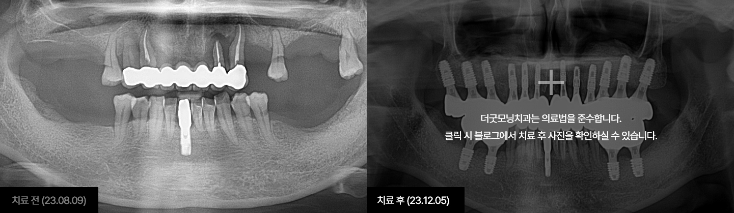 임플란트 케이스 1