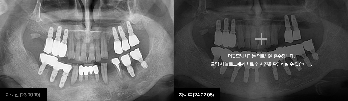 임플란트 케이스 2