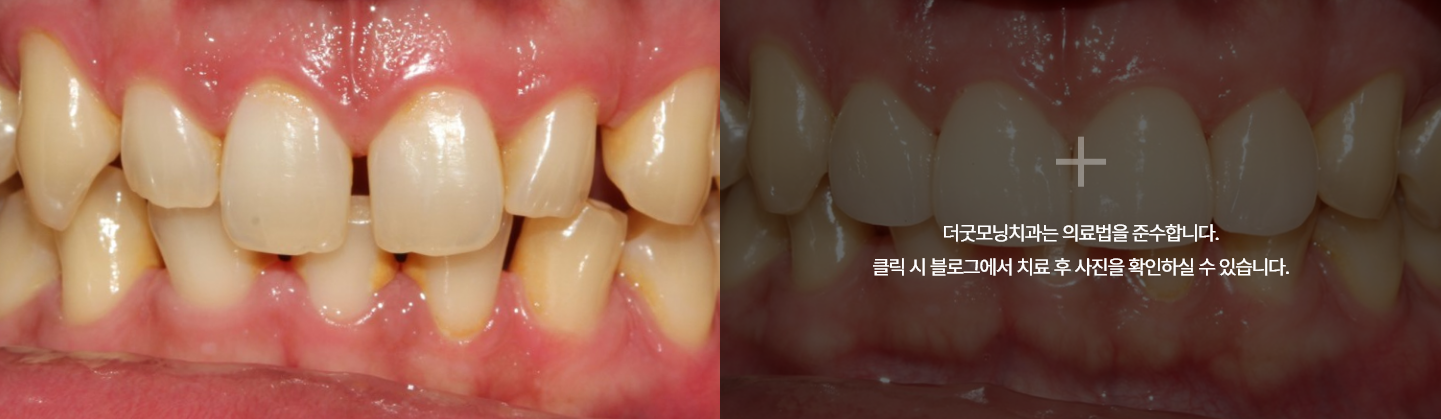 라미네이트 케이스 1