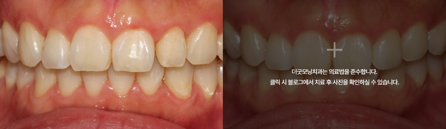 라미네이트 케이스 3