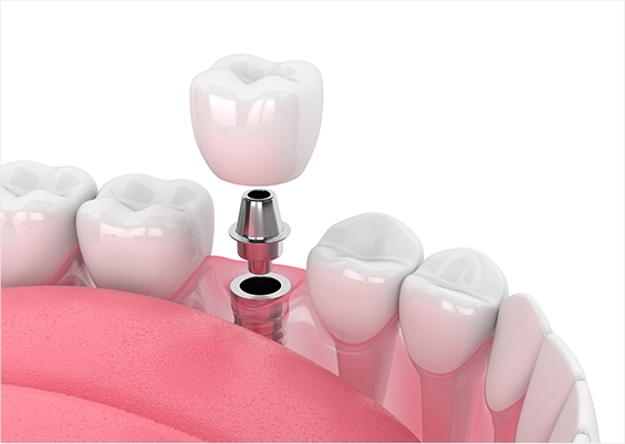 원데이 임플란트 설명