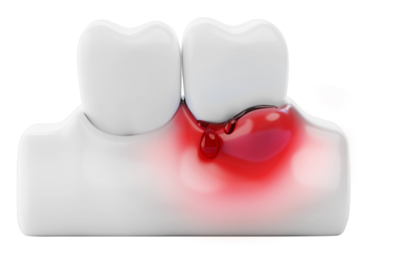 치주염 설명 사진