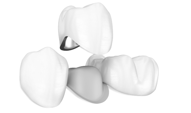 보철 설명 사진