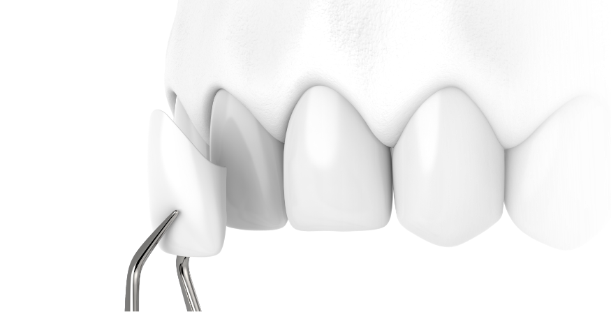 앞니 라미네이트 접합 설명사진