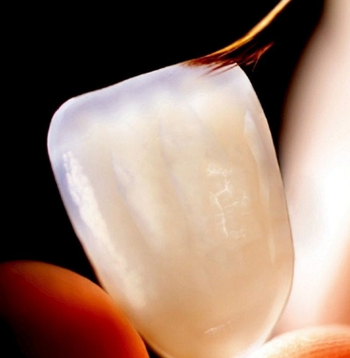 라미네이트의 장점